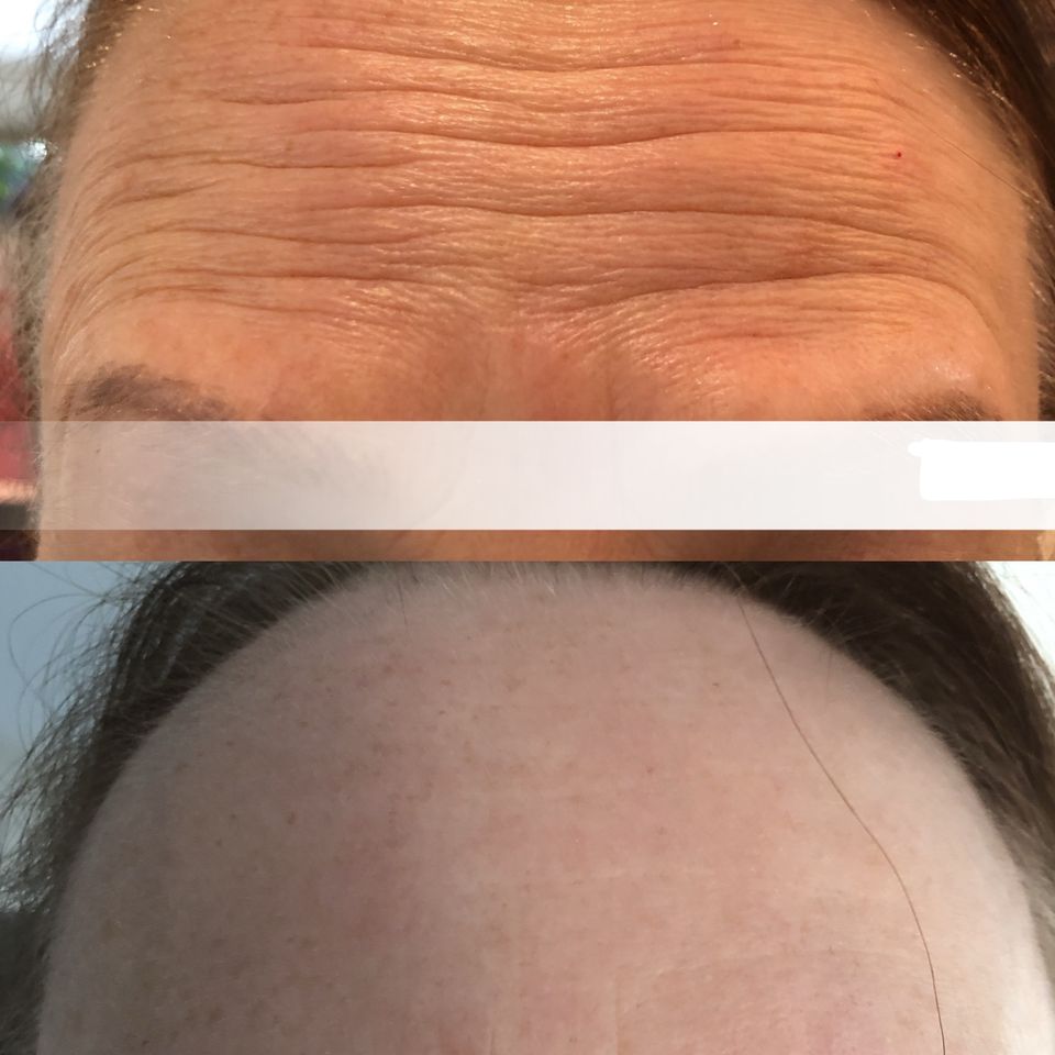 Botox3