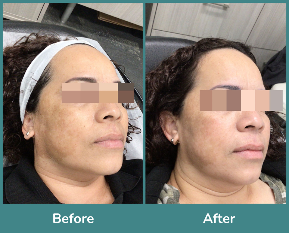 Before after 1