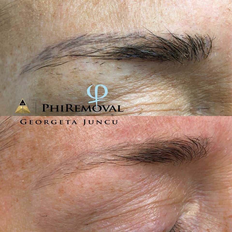 Phiremoval 6
