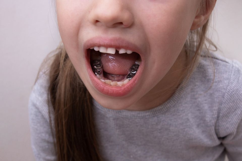 Close-up of child’s teeth during dental exam