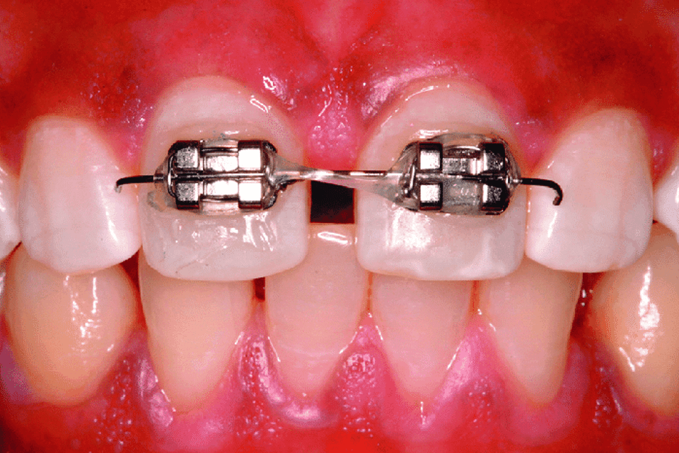 Limited orthodontic treatment