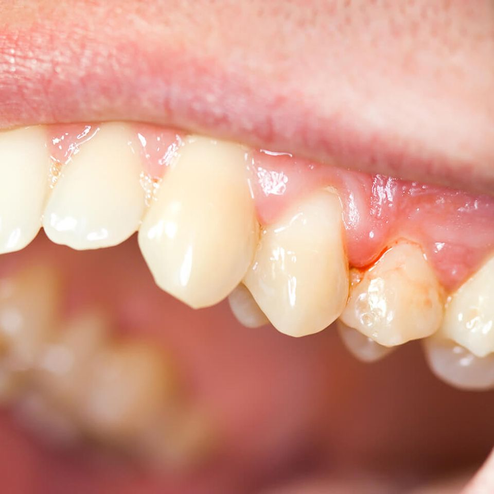Humbertroaddentistry gingivitis