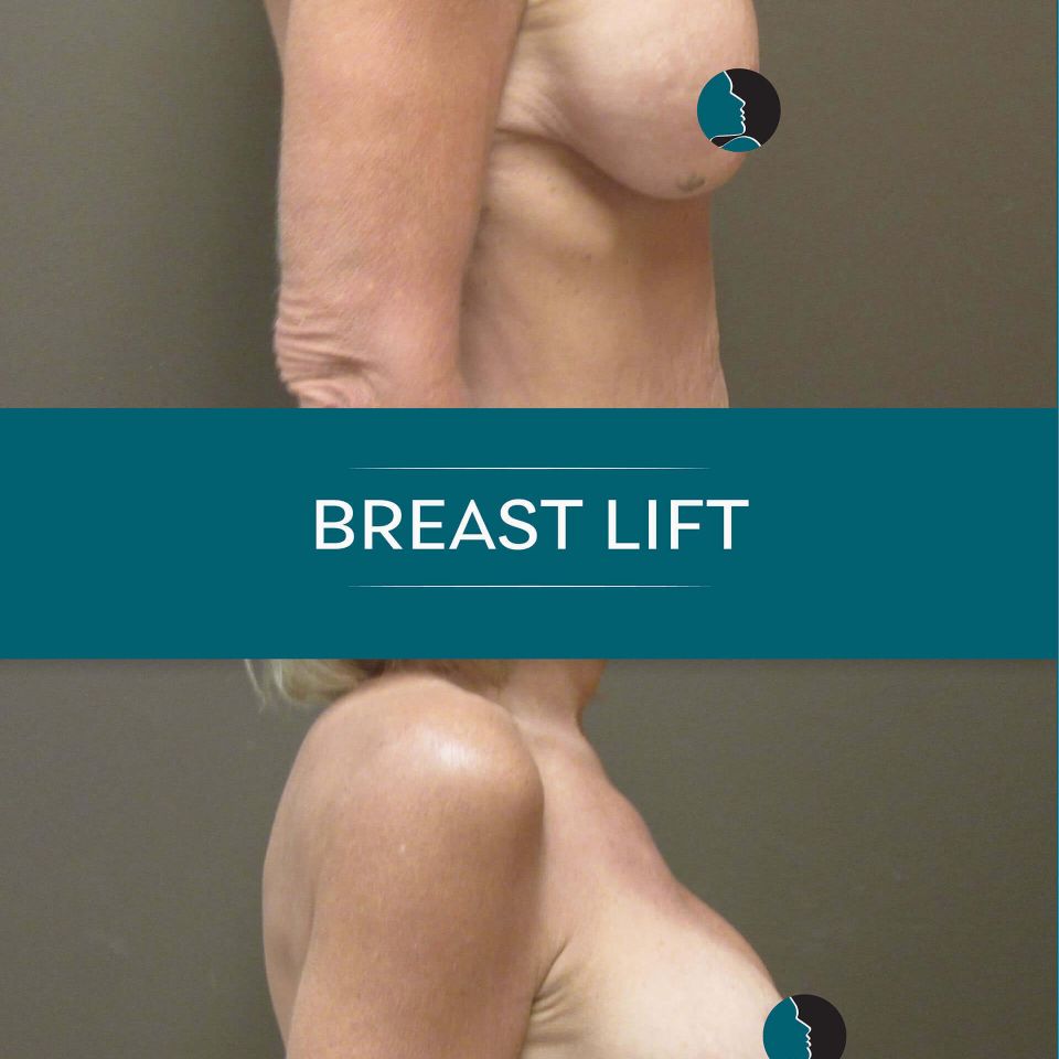 Nps social breasts lift 05
