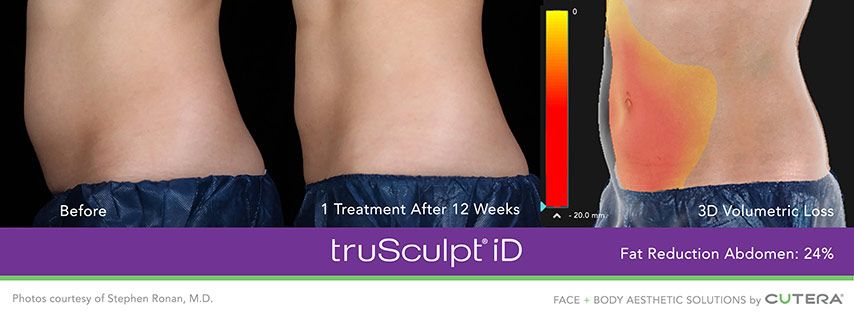 Trusculpt id before and after 18