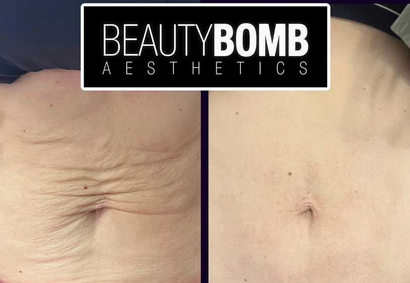 Morpheus8 treatment smithtown ny beauty bomb belly skin tightening