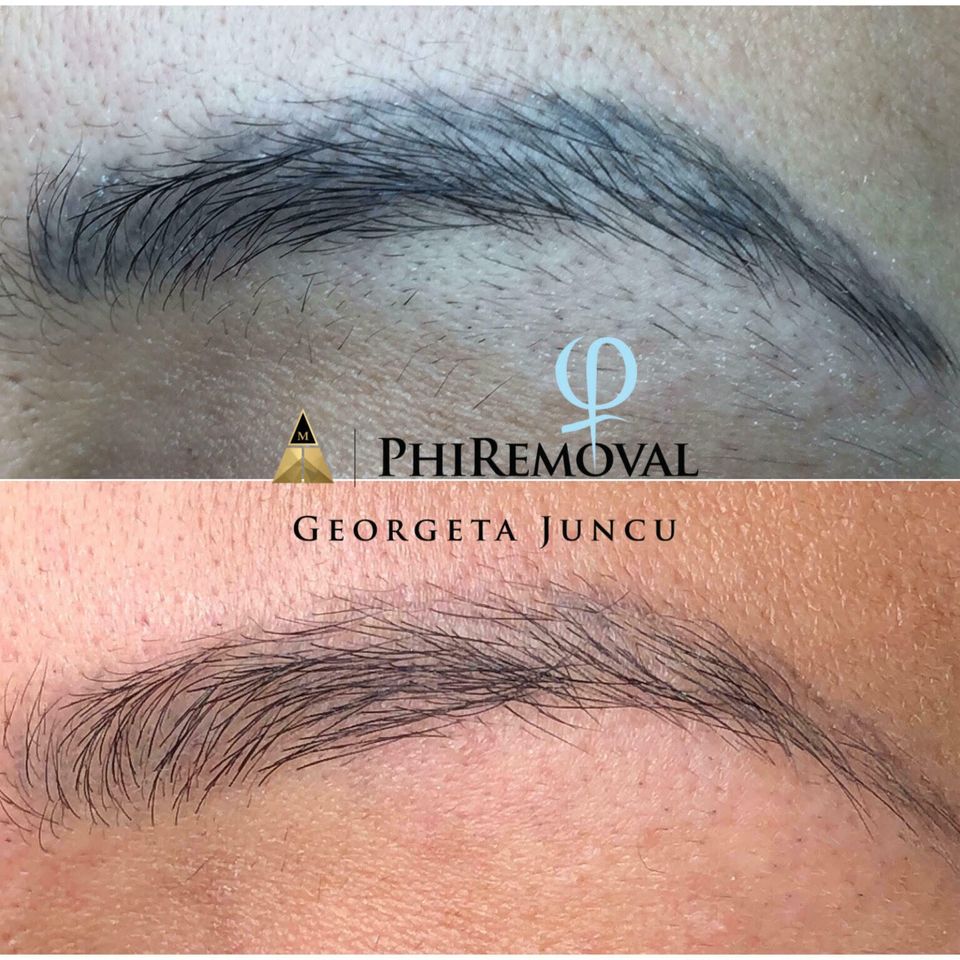 Phiremoval 2