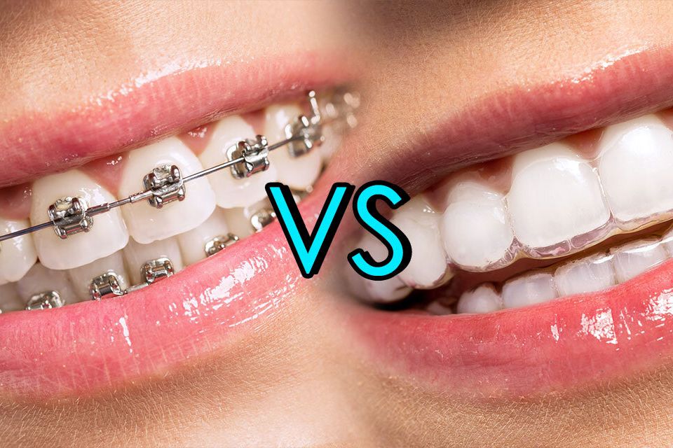 Invisalign vs braces