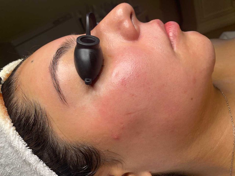 Dermaplaning facial