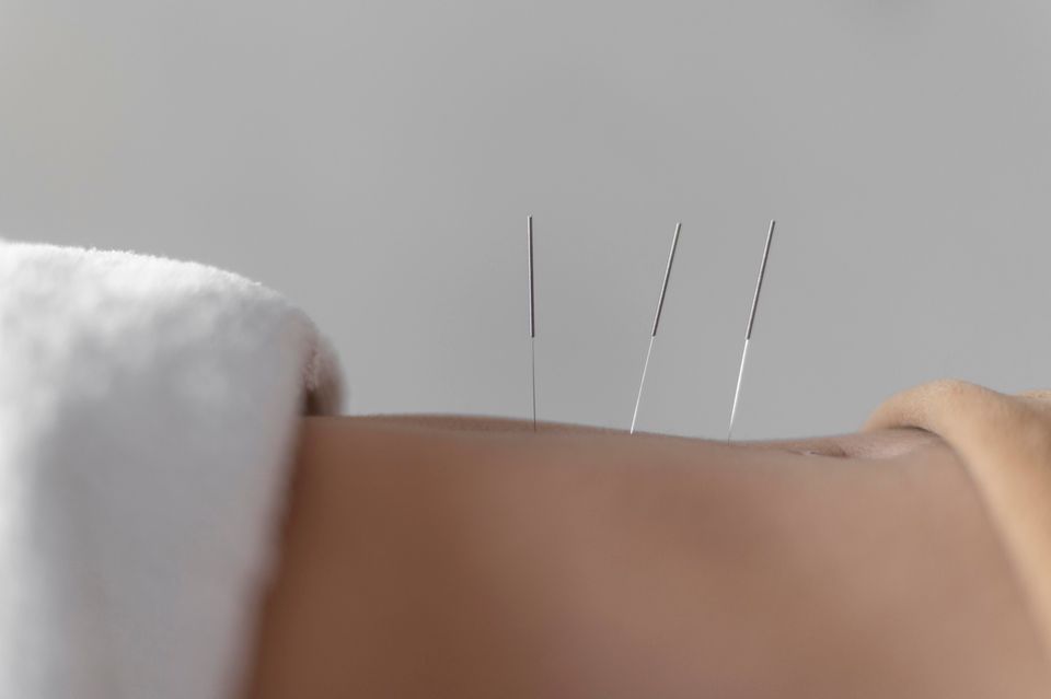 Close up acupuncture procedure