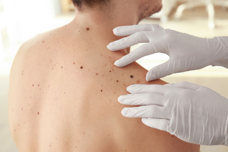 Mohs Procedure in Logan, Utah