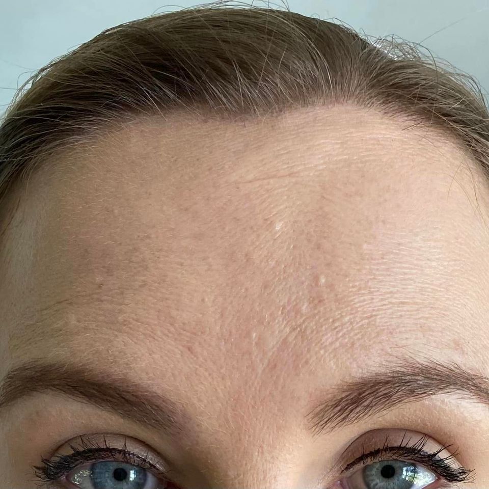 forehead lines after
