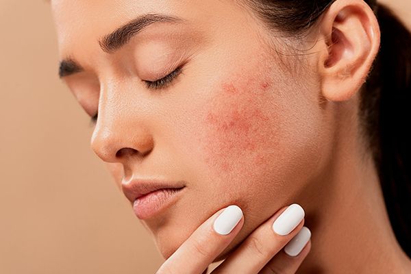 Treatment Hydrodermabrasion Facial