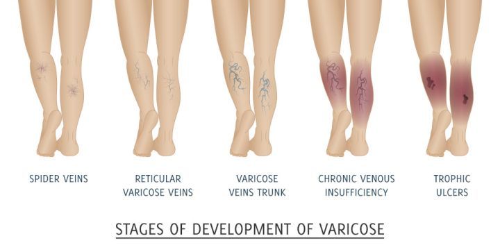 Stages venous insufficiency thegem blog timeline large
