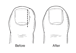 Ingrowntoenail
