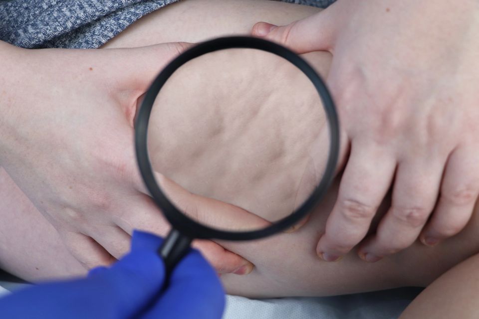 A doctor examines a patients leg with lipodystrophy.
