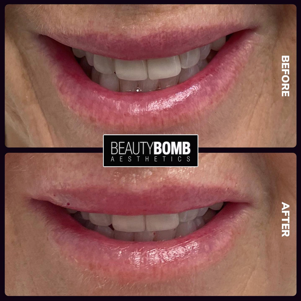 Beauty bomb lips before and after