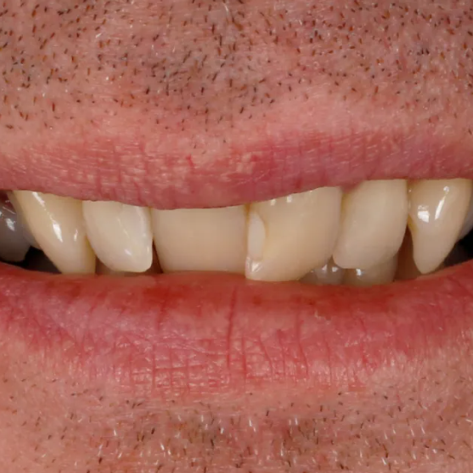 Bad teeths