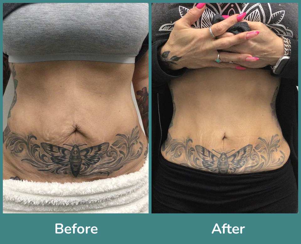 Before after 9