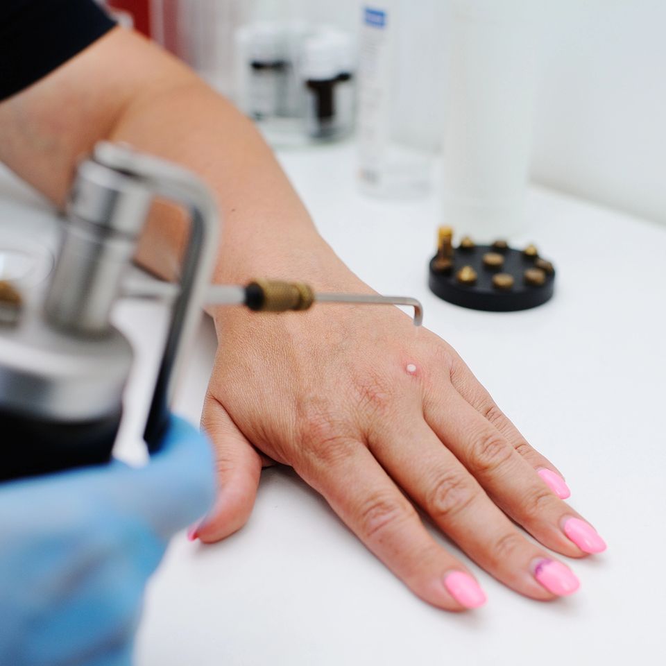 Wart removal