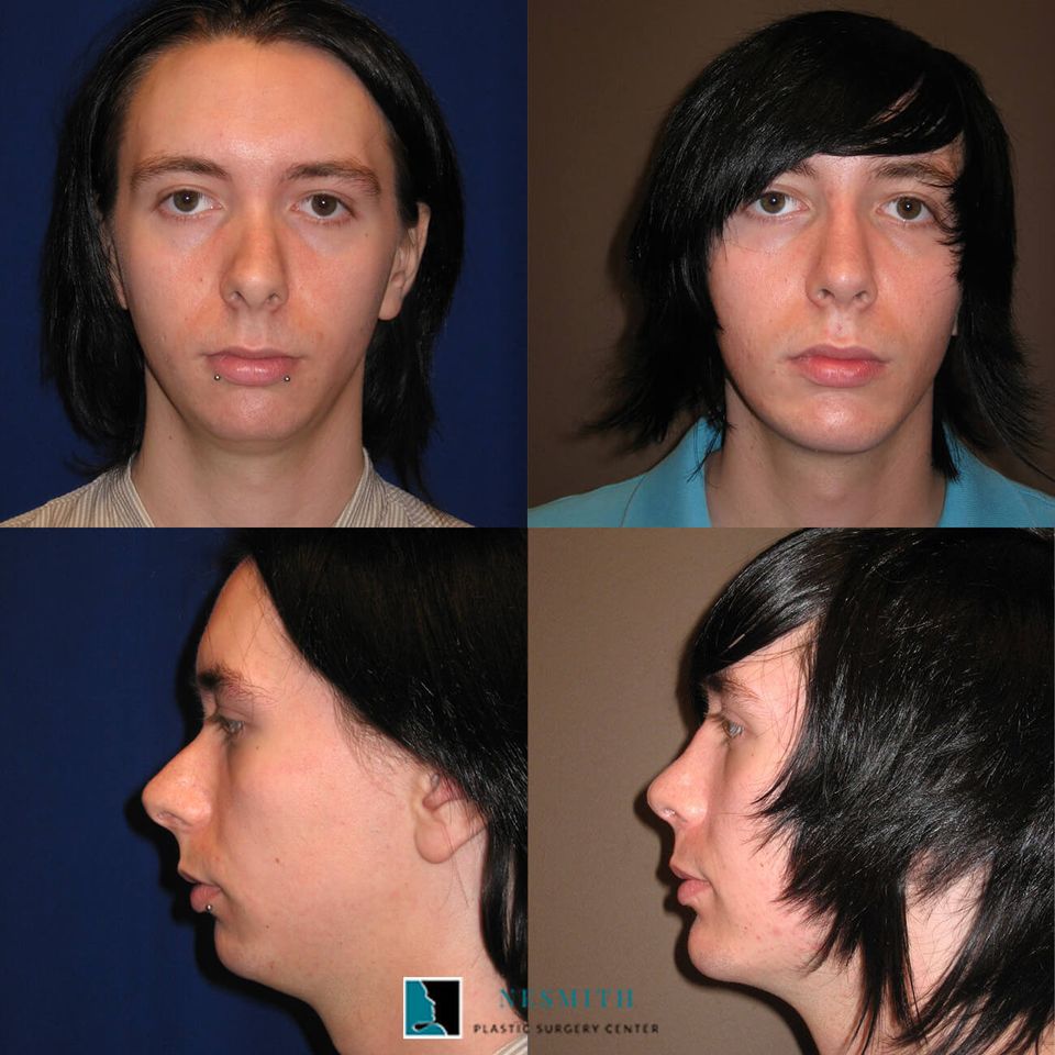 Nose surgery rinoplasty 2