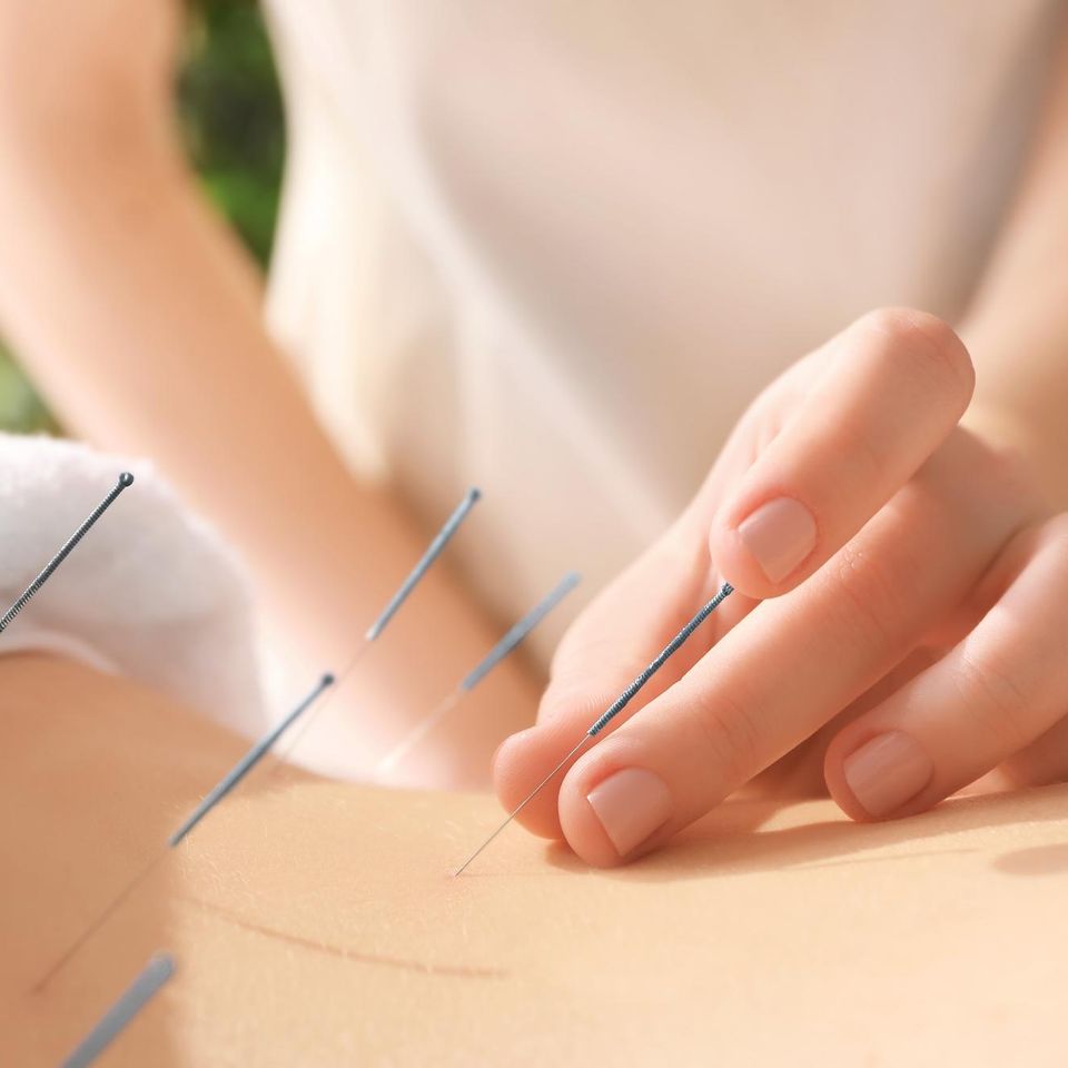 Book an Acupuncturist