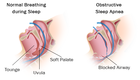 Pediatric Obstructive Sleep Apnea