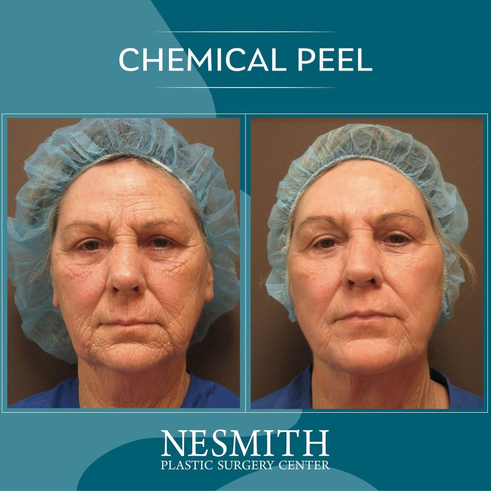 Nps social peel 01