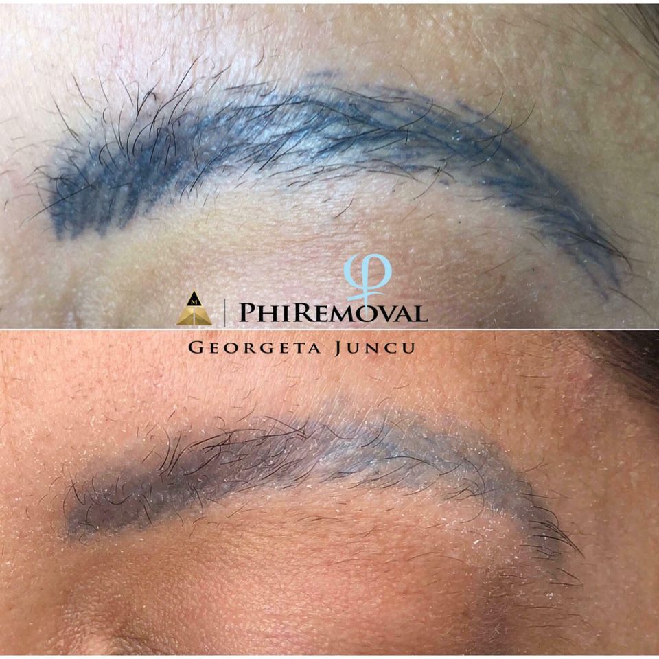 Phiremoval 4