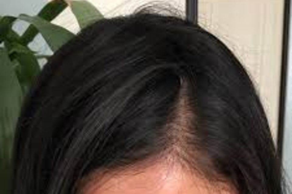 Hair recovery treatment