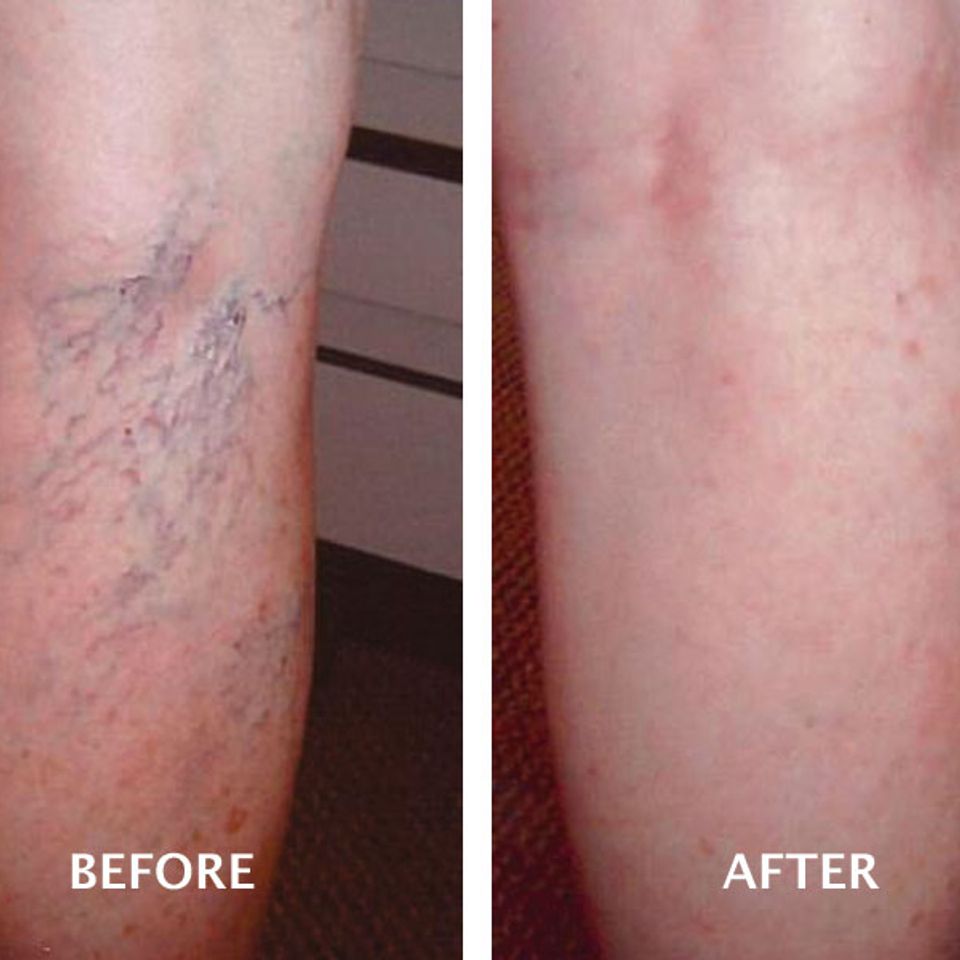 Spider veins before after