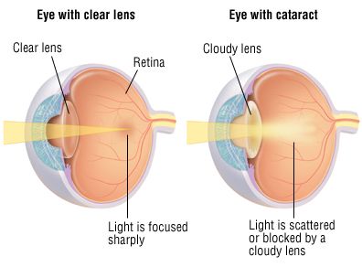 Cataracts