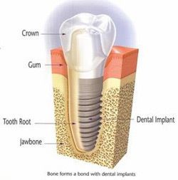 Dental Implant | Skinworks Meridian Idaho