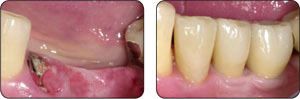 Implant Dentistry in Nampa Idaho