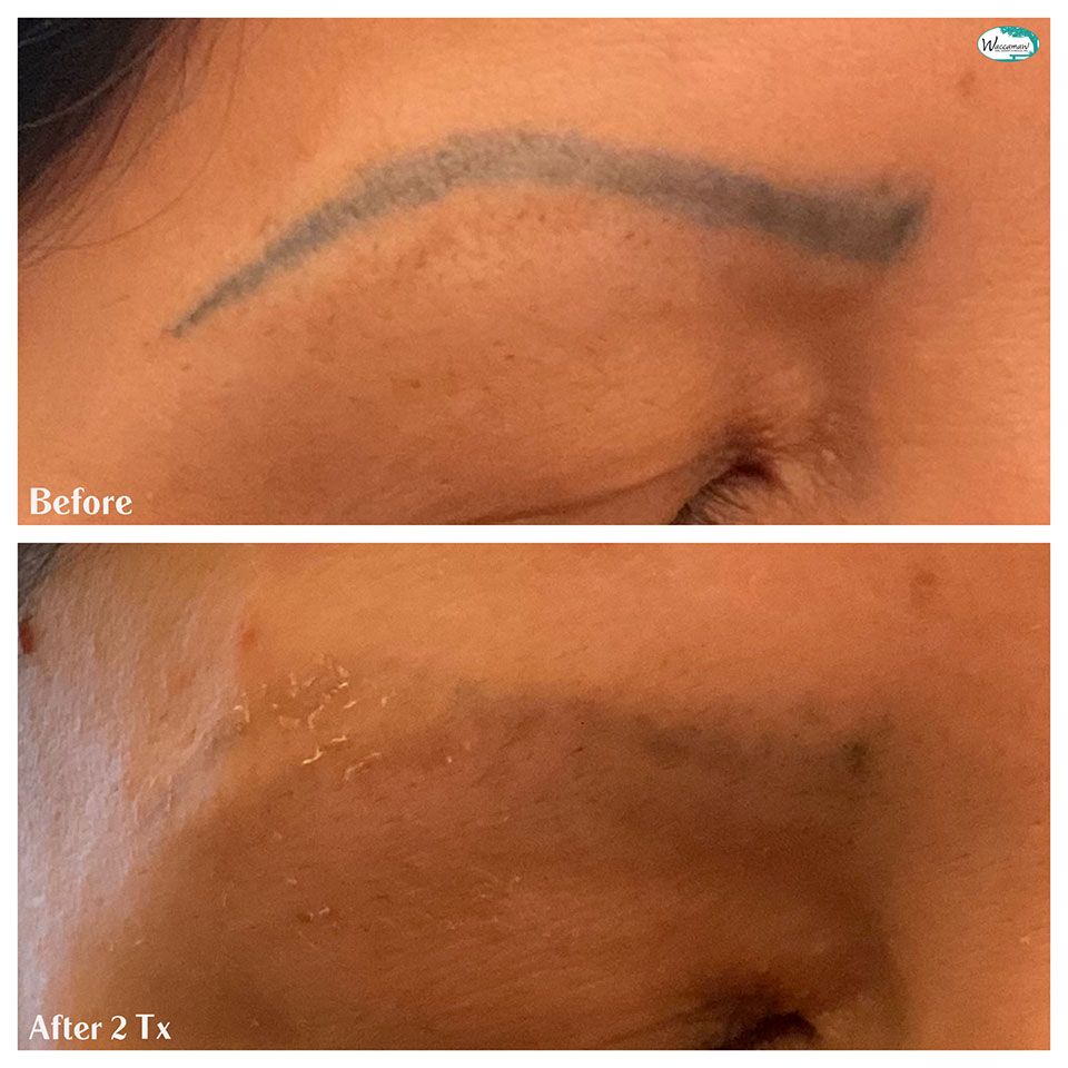 Scar resurfacing before after 1