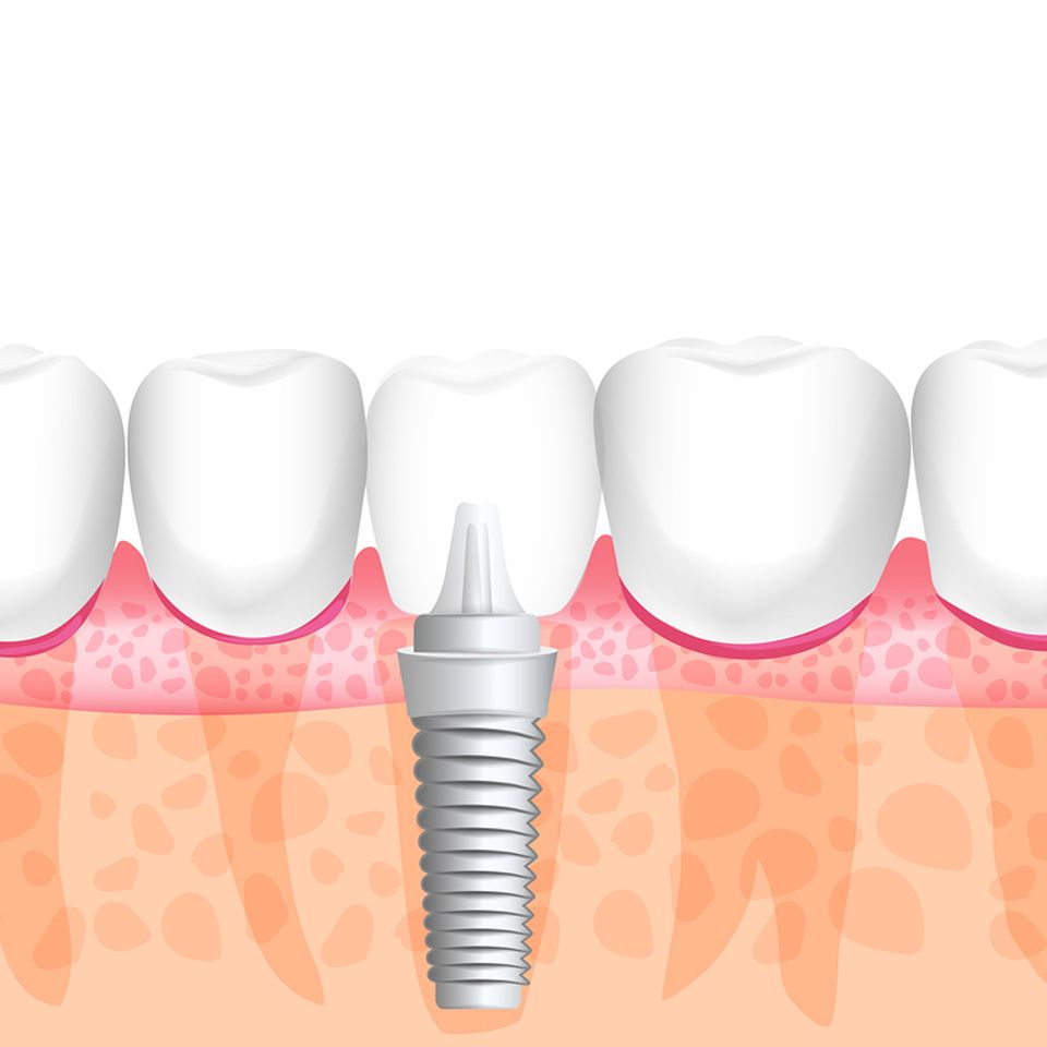 Dental Implants by Johnston Family Dentistry of Smithfield and serving Clayton, NC.