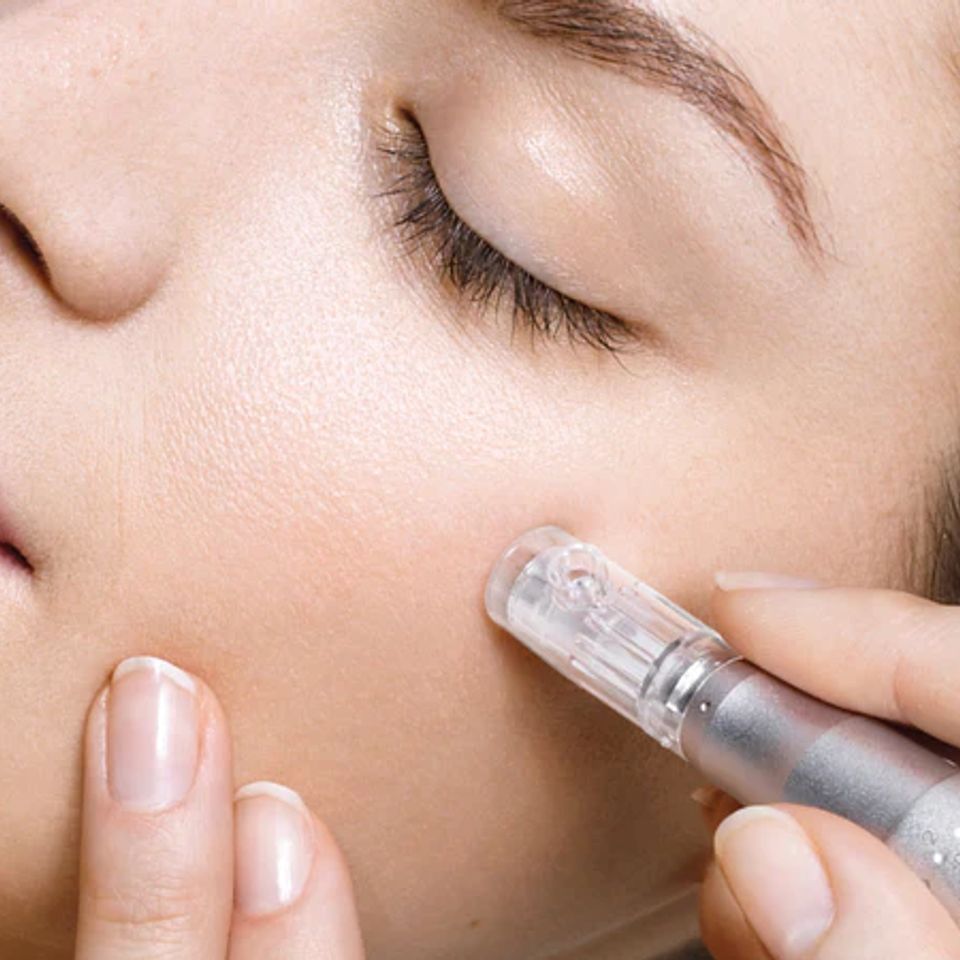 Microneedling1 600x600