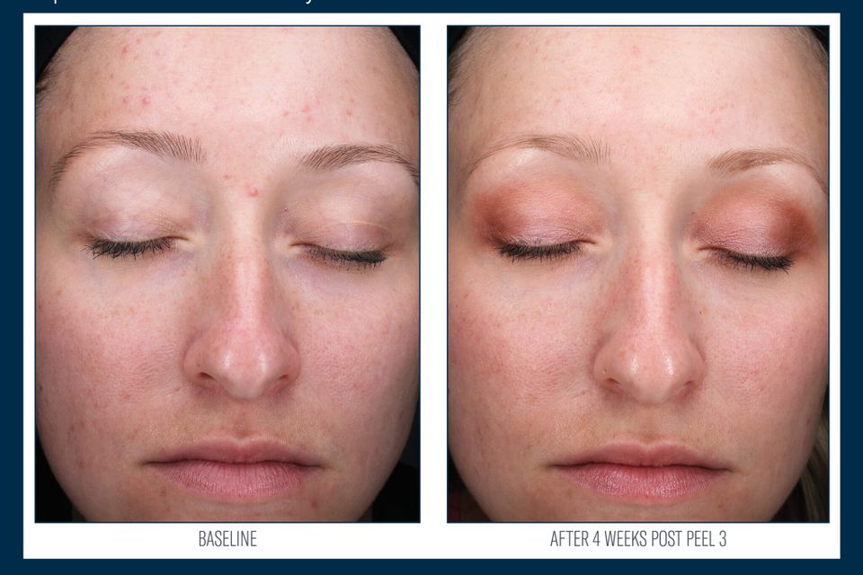 Alpharet professional peel system before after jpeg templatehqp3 2048x1616