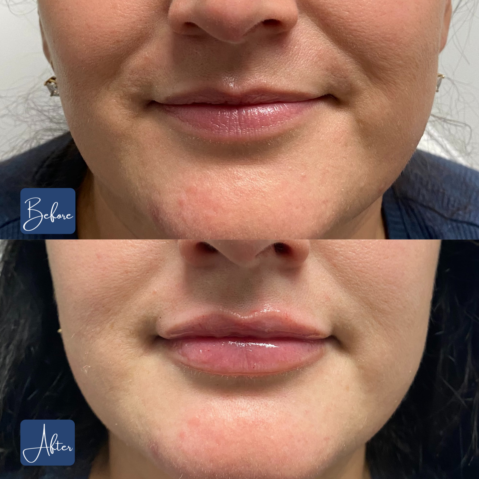 Lips 15