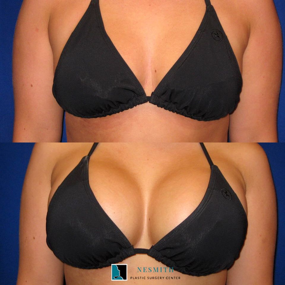 Breast augmentation 1