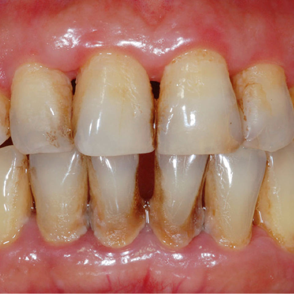 Smoker teeth discoloration