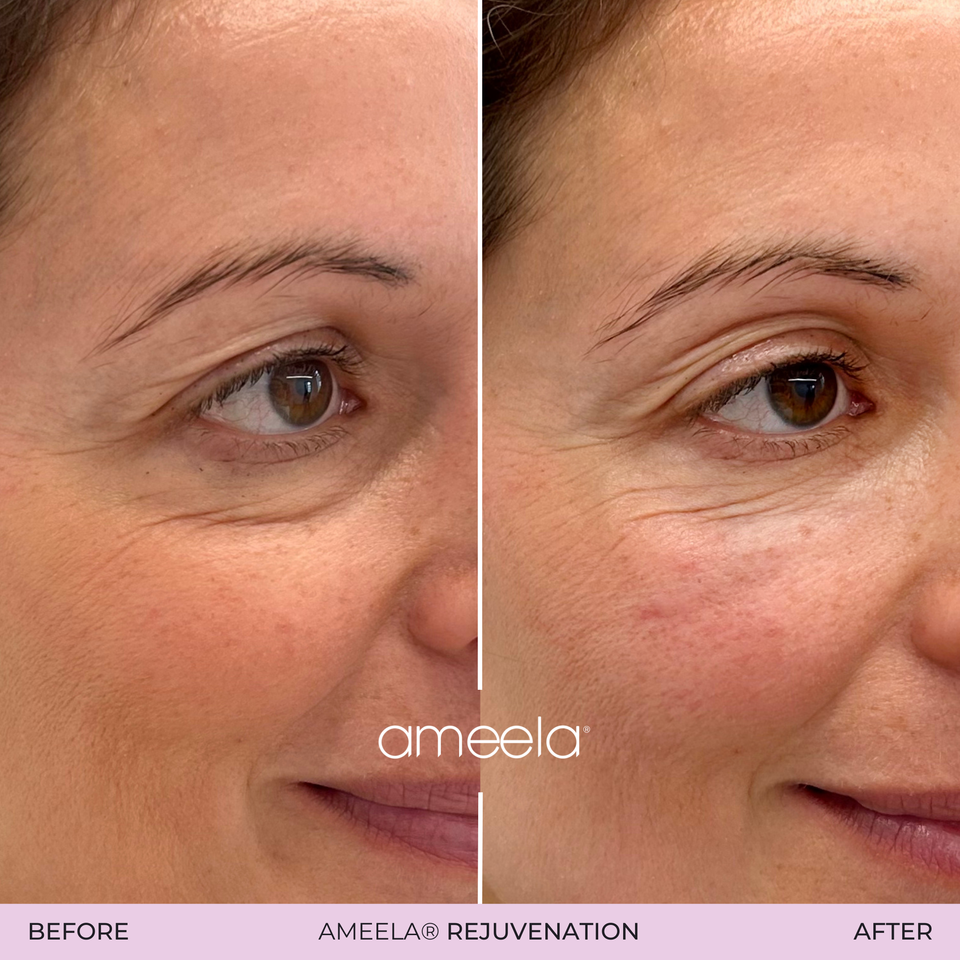 Ameela rejuvenation   before after 05