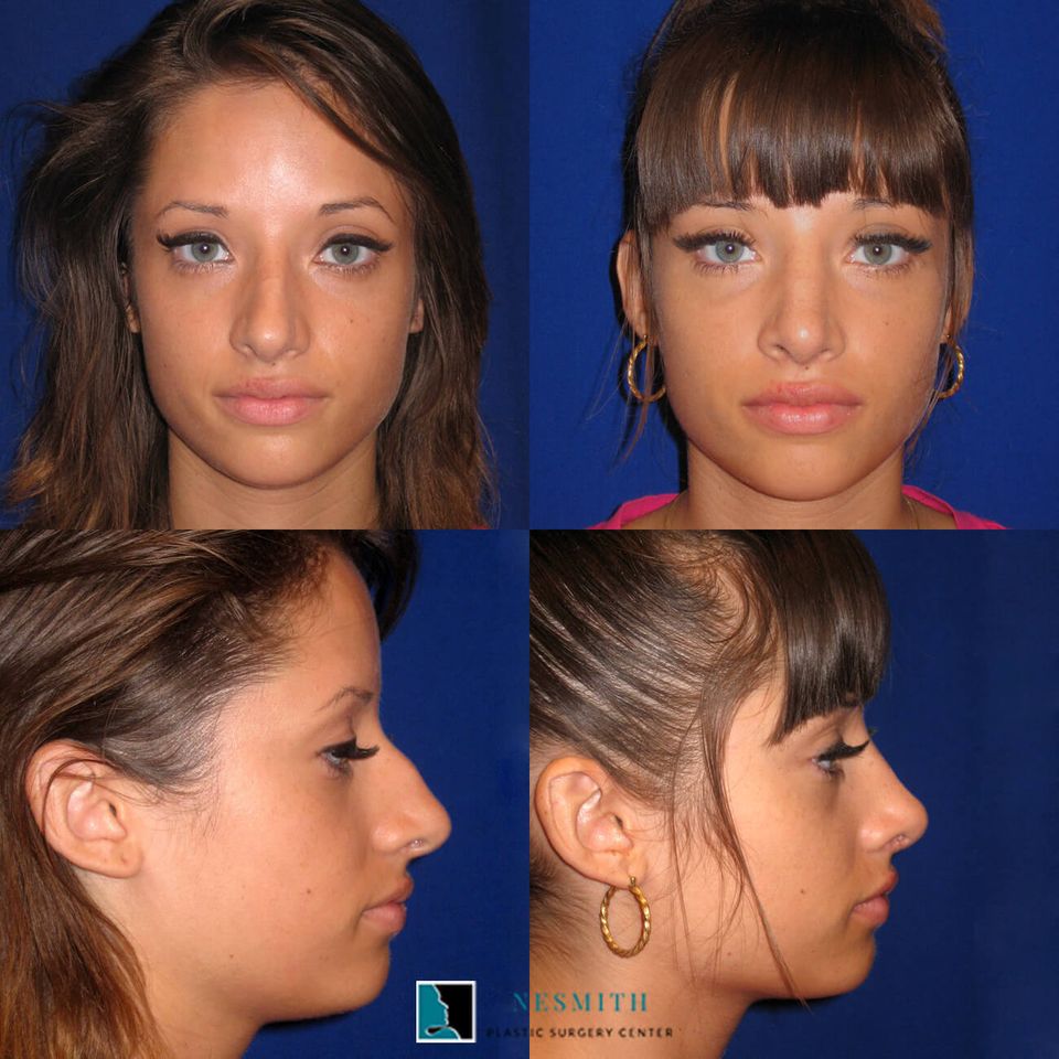 Nose surgery rinoplasty 1