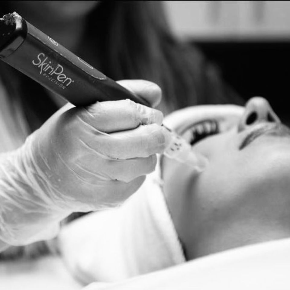 SkinPen Microneedling Beauty Bomb Aesthetics