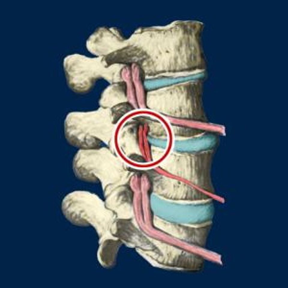 Subluxation still