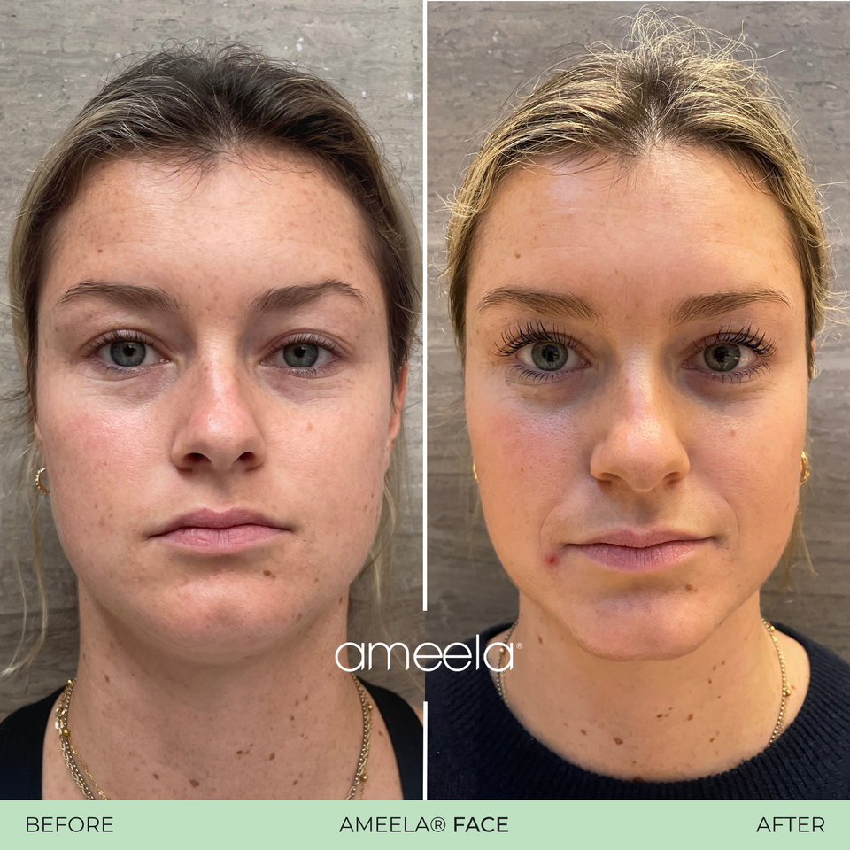 Ameela face   before after 01