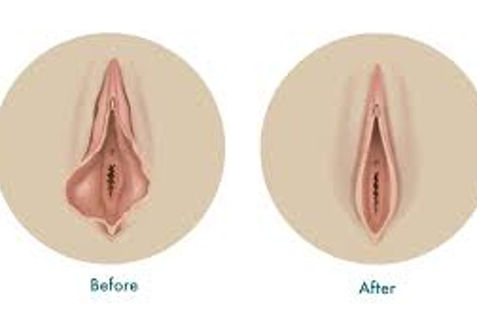 Vaginal rejuvenation 1
