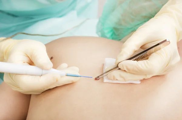 Dermatologist mole removal