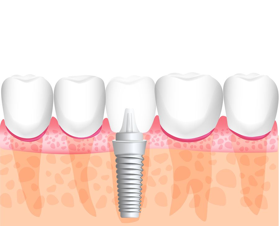 Bigstock realistic dental implant struc 301293226