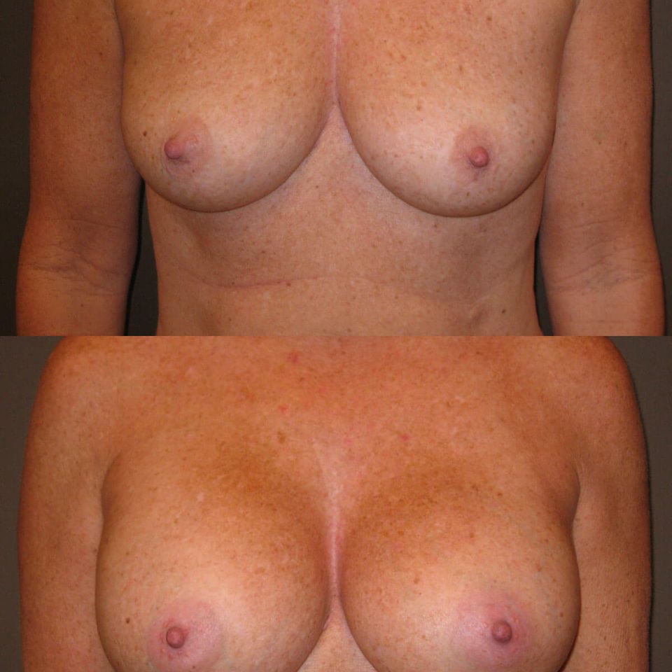 Breast augmentation 4