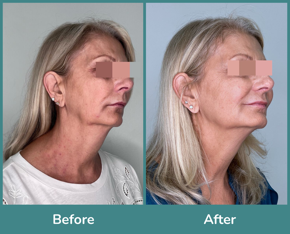 Before after 6